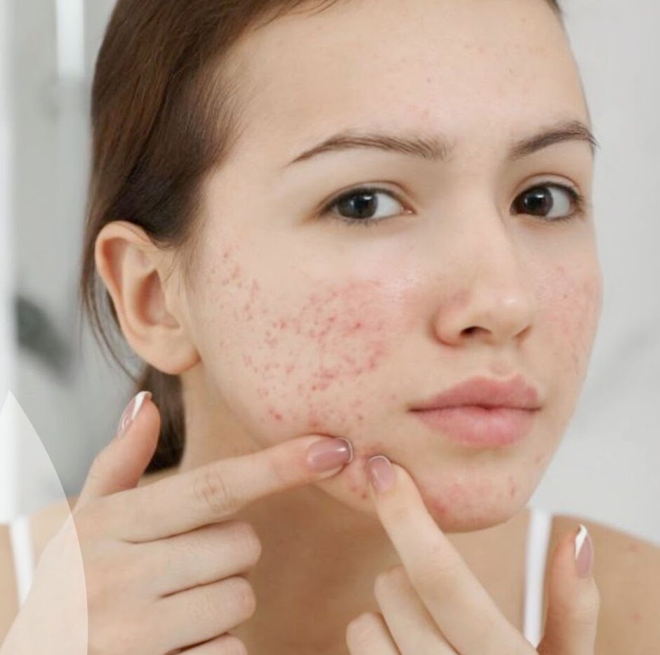 Acne behandeling praktijk savoir ieper 1 e1778846661548