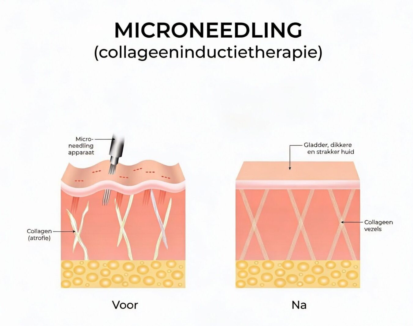microneedling collageen litteken behandeling praktijk savoir ieper e1789460364226